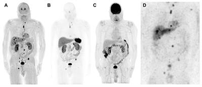 Case Series: ATRX Variants in Four Patients with Metastatic Pheochromocytoma